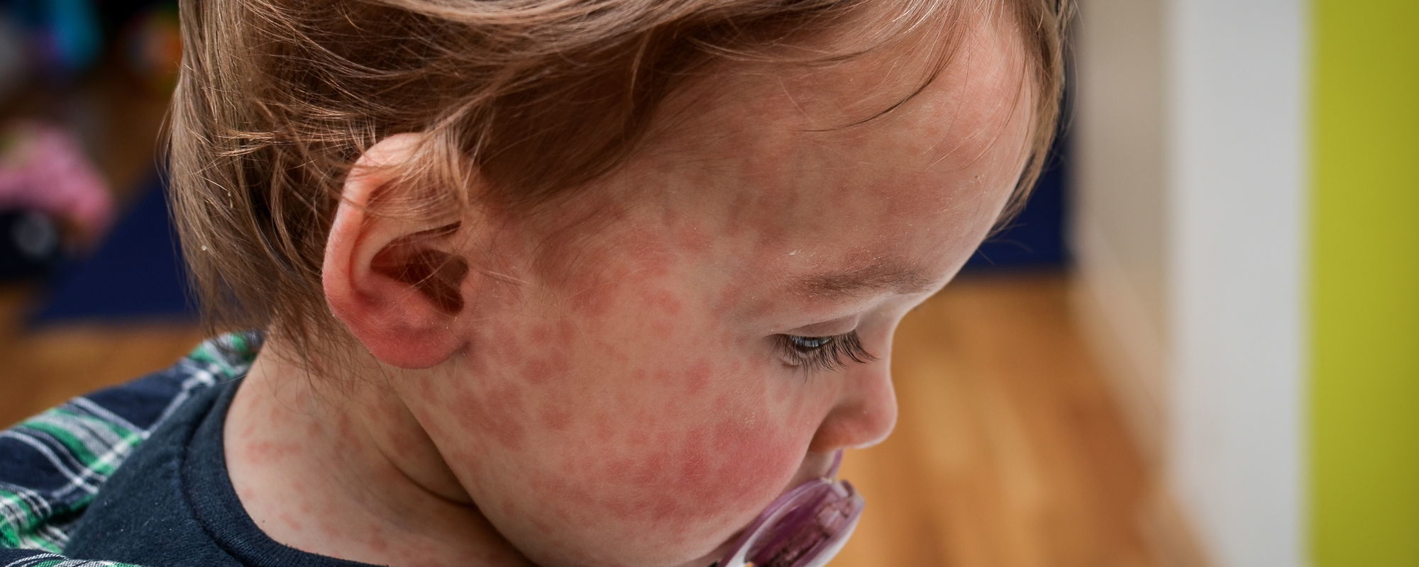 Foto bij Laat je kinderen vaccineren tegen mazelen